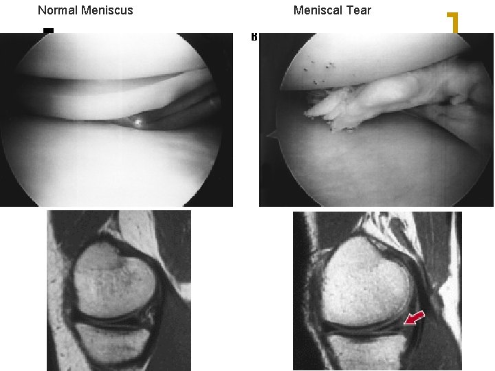 Normal Meniscus Meniscal Tear 