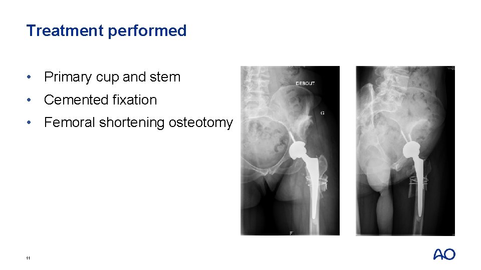 Treatment performed • Primary cup and stem • Cemented fixation • Femoral shortening osteotomy