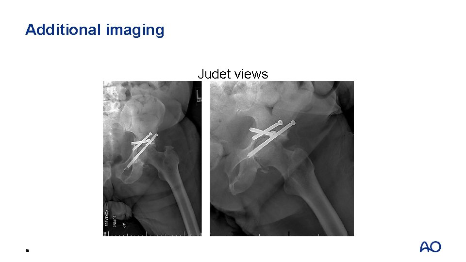 Additional imaging Judet views 18 