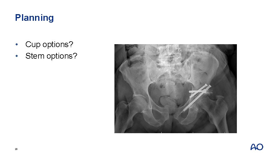 Planning • Cup options? • Stem options? 20 