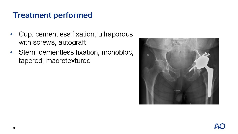 Treatment performed • Cup: cementless fixation, ultraporous with screws, autograft • Stem: cementless fixation,