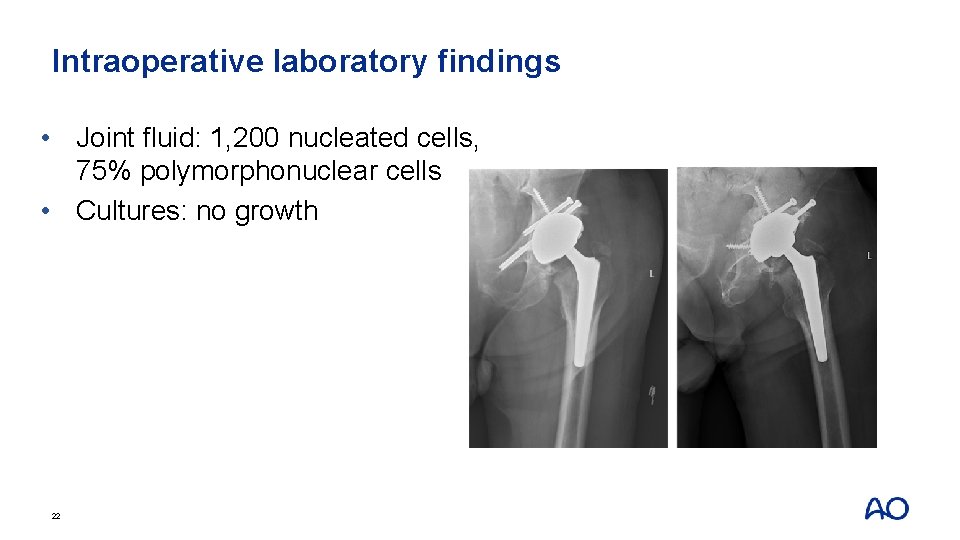 Intraoperative laboratory findings • Joint fluid: 1, 200 nucleated cells, 75% polymorphonuclear cells •