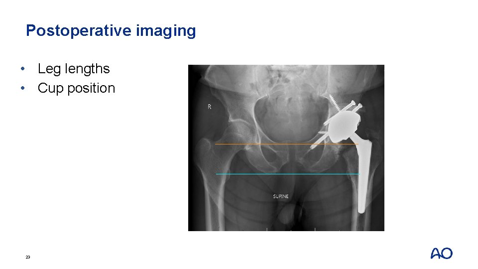 Postoperative imaging • Leg lengths • Cup position 23 