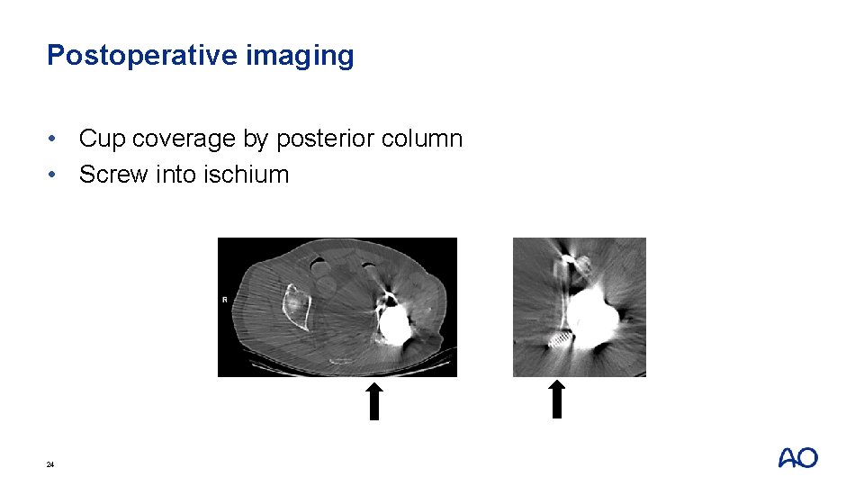 Postoperative imaging • Cup coverage by posterior column • Screw into ischium 24 