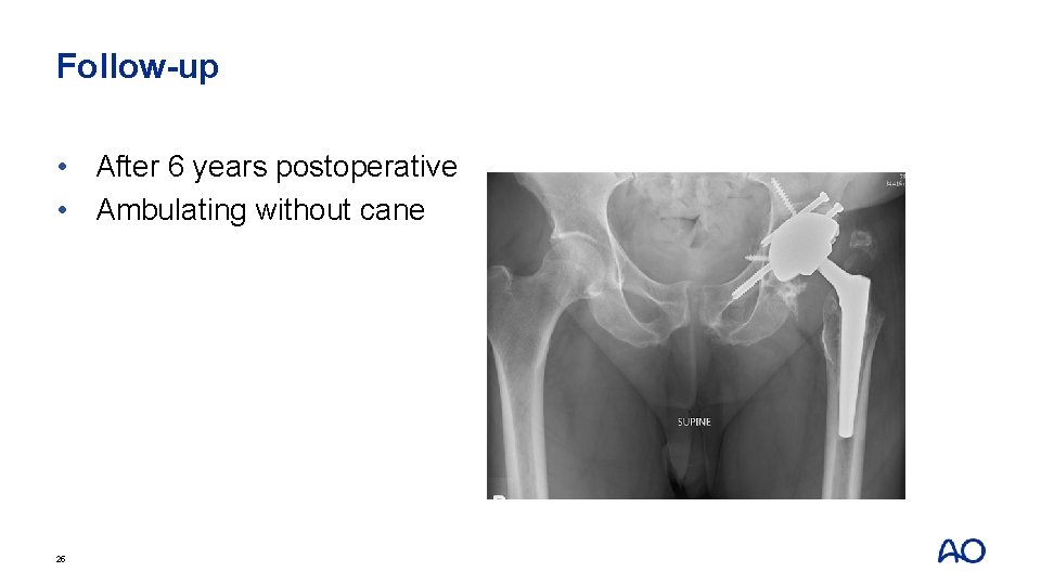 Follow-up • After 6 years postoperative • Ambulating without cane 25 