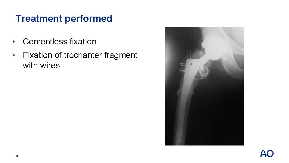 Treatment performed • Cementless fixation • Fixation of trochanter fragment with wires 34 