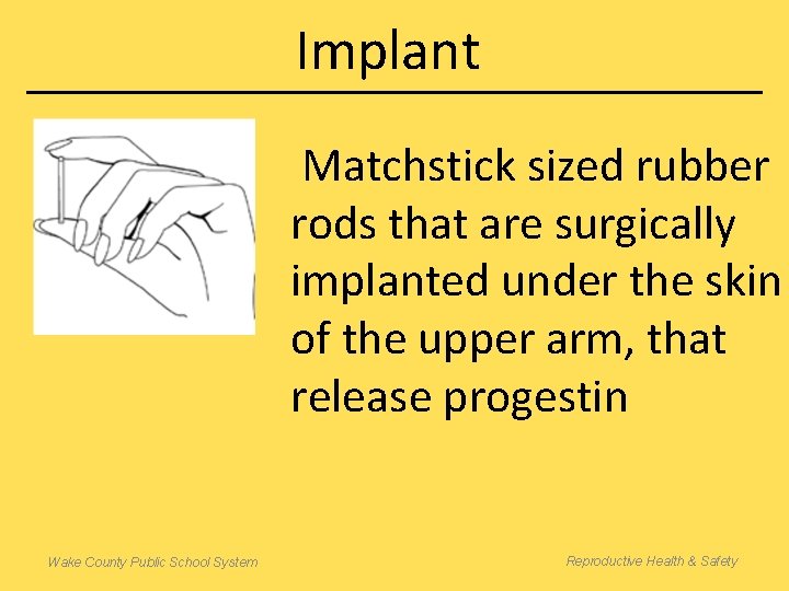 Implant Matchstick sized rubber rods that are surgically implanted under the skin of the