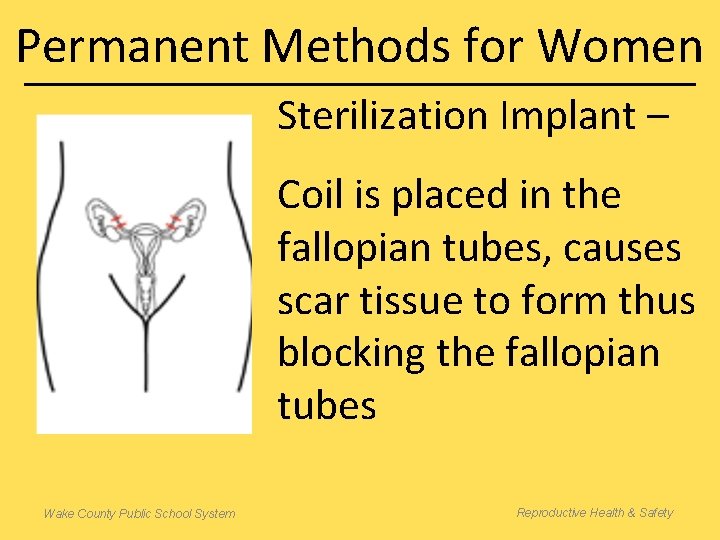 Permanent Methods for Women Sterilization Implant – Coil is placed in the fallopian tubes,