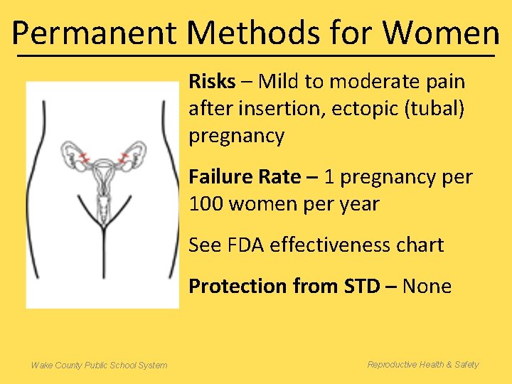 Permanent Methods for Women Risks – Mild to moderate pain after insertion, ectopic (tubal)
