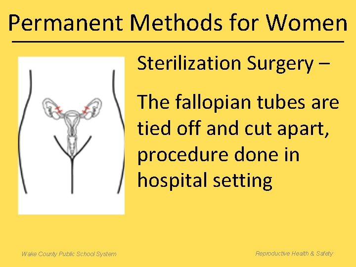 Permanent Methods for Women Sterilization Surgery – The fallopian tubes are tied off and