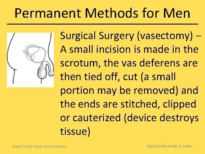 Permanent Methods for Men Surgical Surgery (vasectomy) – A small incision is made in