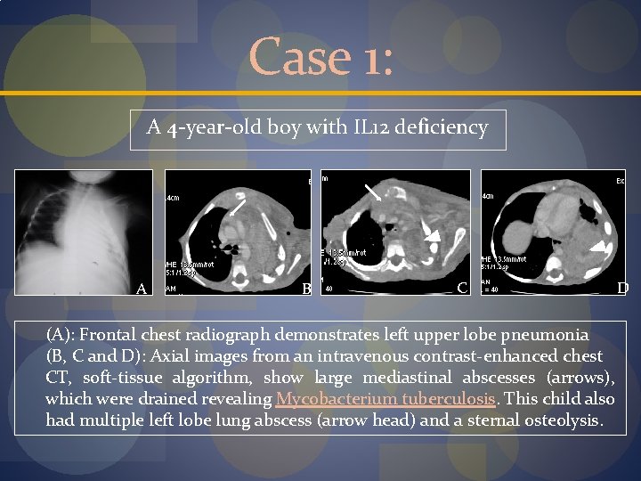 Case 1: A 4 -year-old boy with IL 12 deficiency A B C (A):