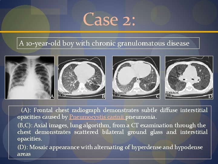 Case 2: A 10 -year-old boy with chronic granulomatous disease A B C (A):