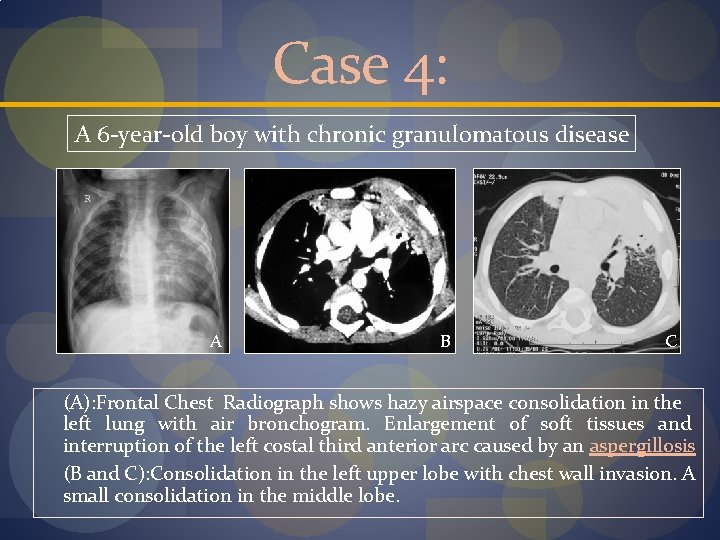 Case 4: A 6 -year-old boy with chronic granulomatous disease A B C (A):