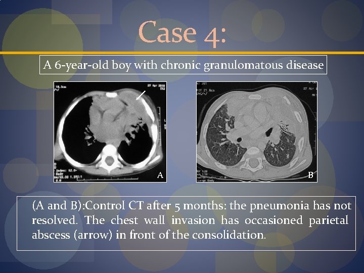Case 4: A 6 -year-old boy with chronic granulomatous disease A B (A and