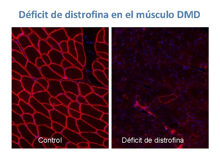 Déficit de distrofina en el músculo DMD Control Déficit de distrofina Déficit de distrofina en el músculo DMD Control Déficit de distrofina