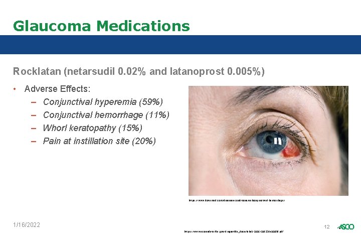 Glaucoma Medications Rocklatan (netarsudil 0. 02% and latanoprost 0. 005%) • Adverse Effects: –