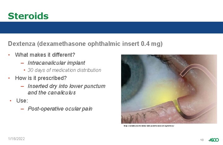 Steroids Dextenza (dexamethasone ophthalmic insert 0. 4 mg) • What makes it different? –