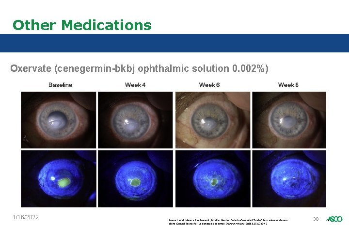 Other Medications Oxervate (cenegermin-bkbj ophthalmic solution 0. 002%) 1/16/2022 Bonini S et al. Phase