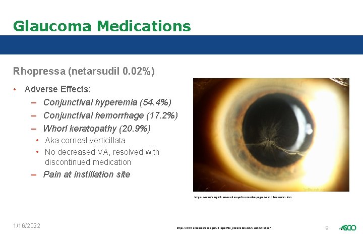 Glaucoma Medications Rhopressa (netarsudil 0. 02%) • Adverse Effects: – Conjunctival hyperemia (54. 4%)