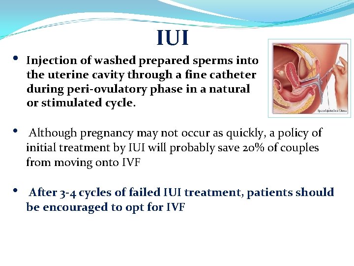 Iui Injection Artificial Assisted Reproductive Techniques ART Dr Sohani Verma