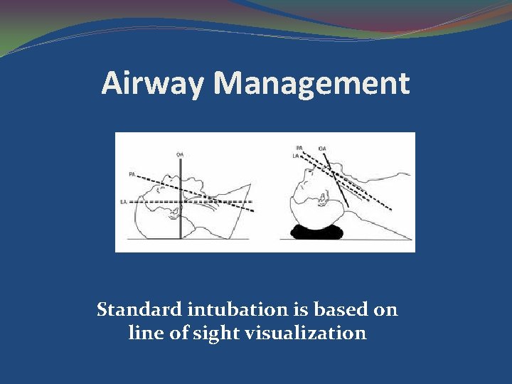 Airway Management Standard intubation is based on line of sight visualization 