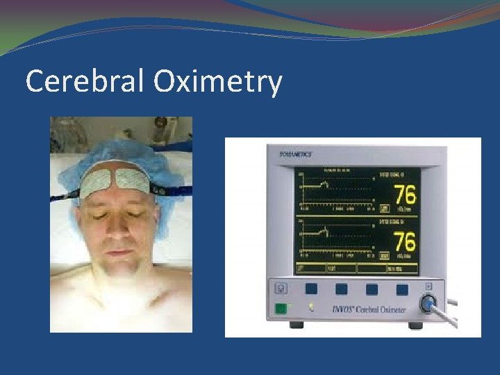 Cerebral Oximetry 