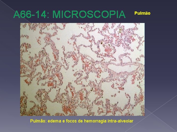 A 66 -14: MICROSCOPIA Pulmão: edema e focos de hemorragia intra-alveolar Pulmão 