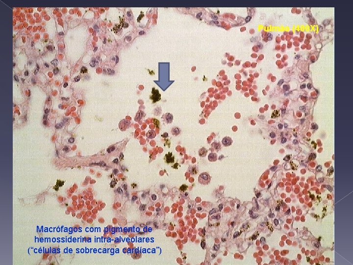 Pulmão (400 X) Macrófagos com pigmento de hemossiderina intra-alveolares (“células de sobrecarga cardíaca”) 