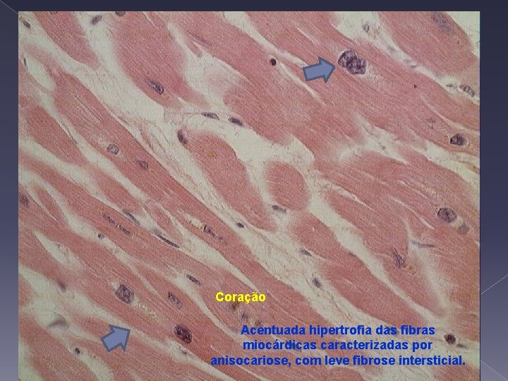 Coração Acentuada hipertrofia das fibras miocárdicas caracterizadas por anisocariose, com leve fibrose intersticial. 