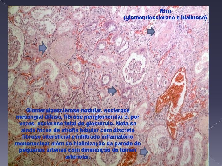 Rim (glomerulosclerose e hialinose) Glomeruloesclerose nodular, esclerose mesangial difusa, fibrose periglomerular e, por vezes,