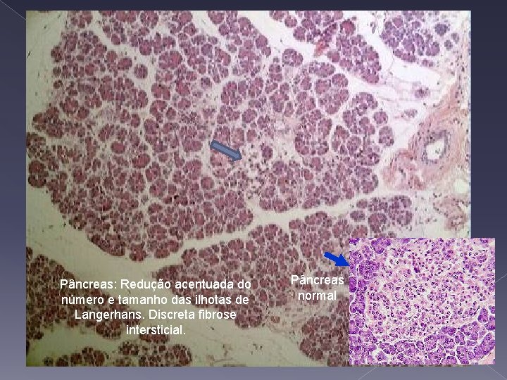 Pâncreas: Redução acentuada do número e tamanho das ilhotas de Langerhans. Discreta fibrose intersticial.