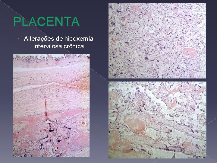 PLACENTA Alterações de hipoxemia intervilosa crônica 