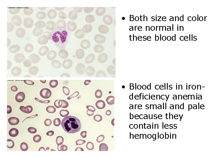  • Both size and color are normal in these blood cells • Blood