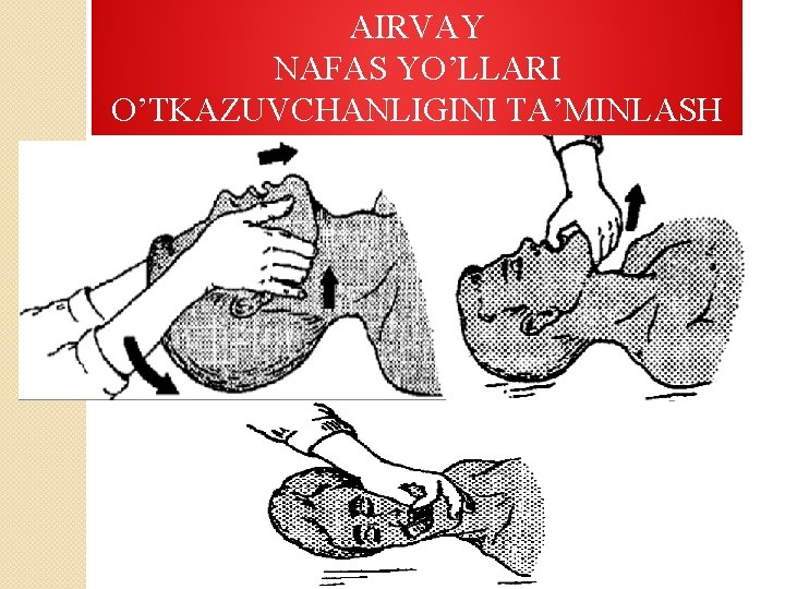 AIRVAY NAFAS YO’LLARI O’TKAZUVCHANLIGINI TA’MINLASH 