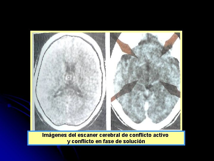 Imágenes del escaner cerebral de conflicto activo y conflicto en fase de solución 