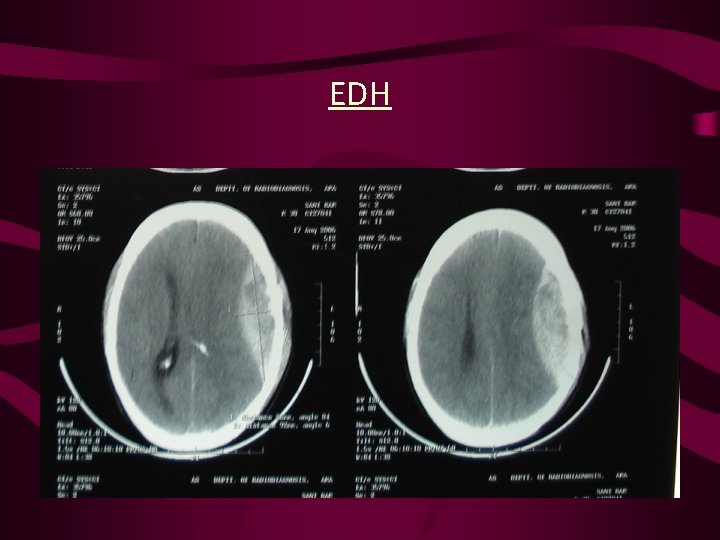 EDH 
