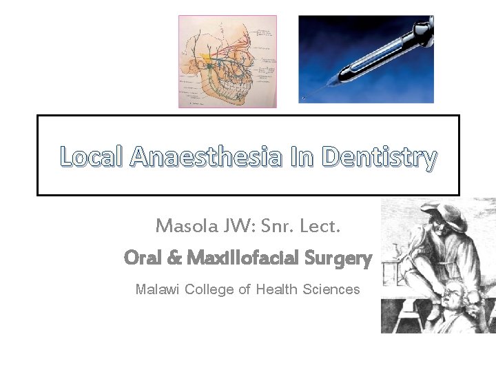 Local Anaesthesia In Dentistry Masola JW: Snr. Lect. Oral & Maxillofacial Surgery Malawi College