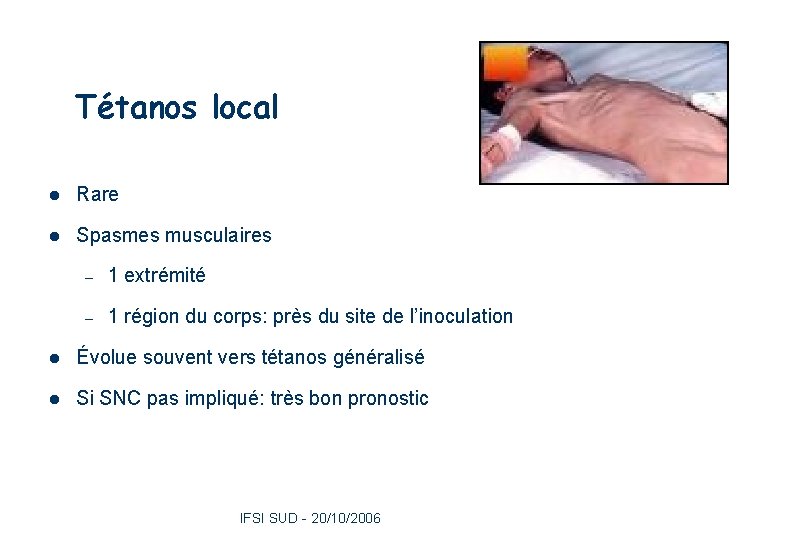 Tétanos local 18 l Rare l Spasmes musculaires – 1 extrémité – 1 région