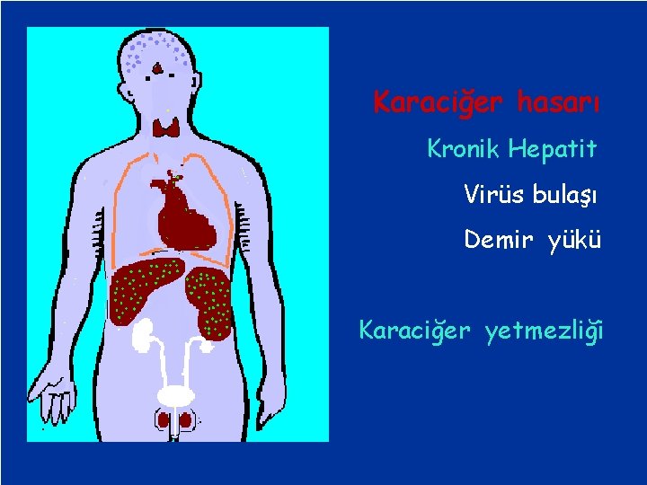 Karaciğer hasarı Kronik Hepatit Virüs bulaşı Demir yükü Karaciğer yetmezliği 