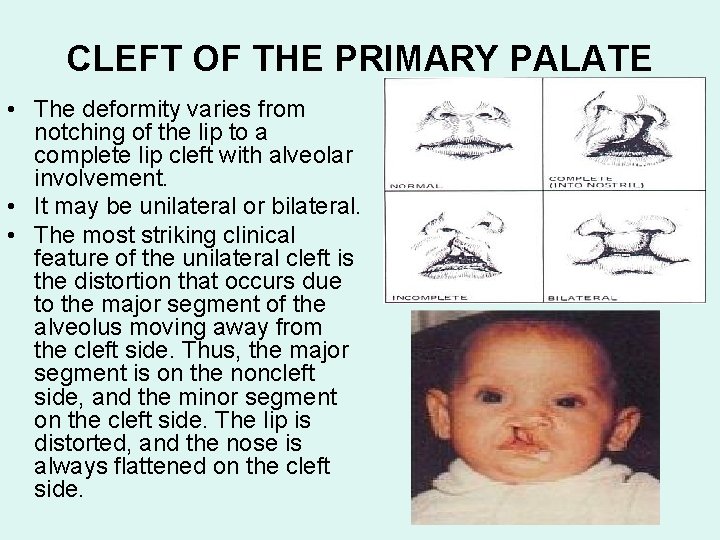 CLEFT OF THE PRIMARY PALATE • The deformity varies from notching of the lip