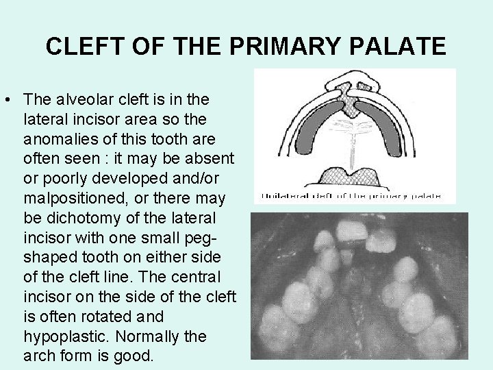 CLEFT OF THE PRIMARY PALATE • The alveolar cleft is in the lateral incisor