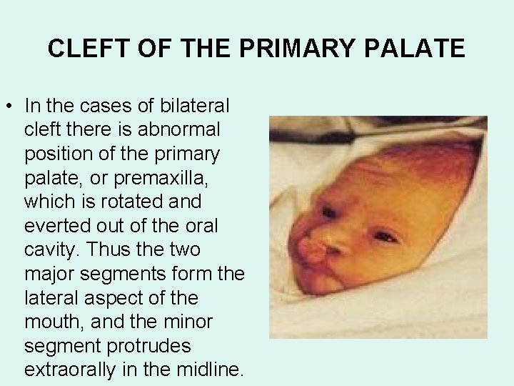 CLEFT OF THE PRIMARY PALATE • In the cases of bilateral cleft there is