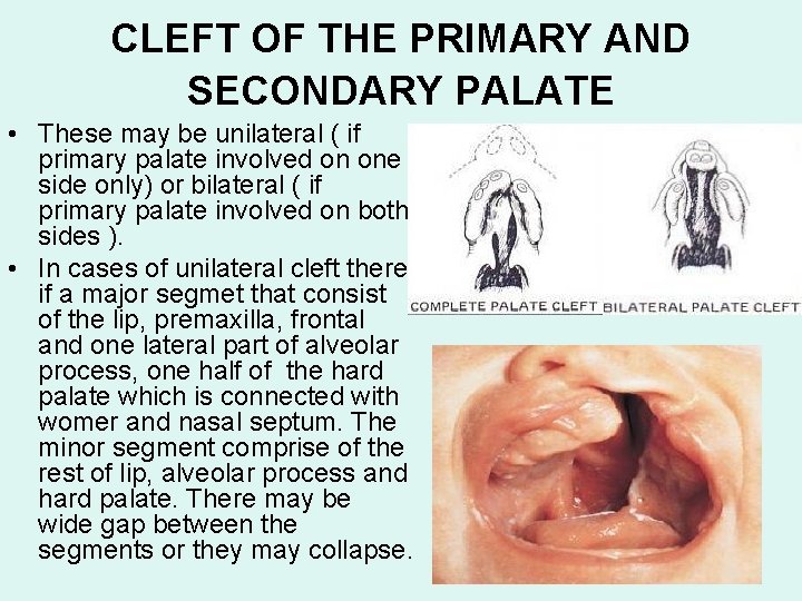 CLEFT OF THE PRIMARY AND SECONDARY PALATE • These may be unilateral ( if