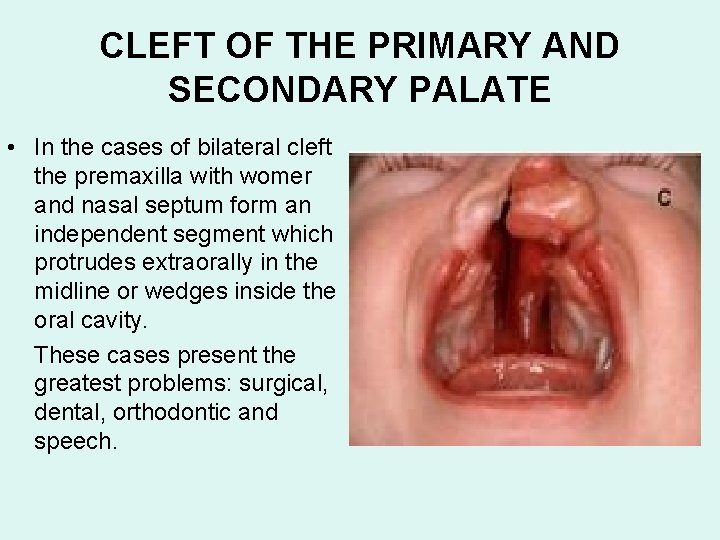 CLEFT OF THE PRIMARY AND SECONDARY PALATE • In the cases of bilateral cleft