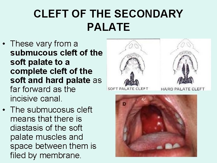 CLEFT OF THE SECONDARY PALATE • These vary from a submucous cleft of the