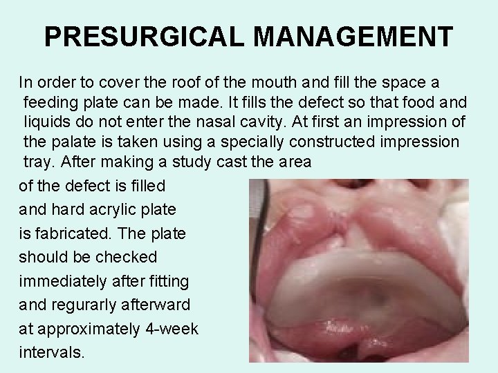 PRESURGICAL MANAGEMENT In order to cover the roof of the mouth and fill the