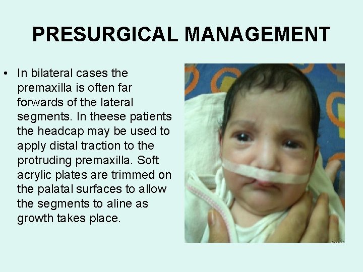 PRESURGICAL MANAGEMENT • In bilateral cases the premaxilla is often far forwards of the