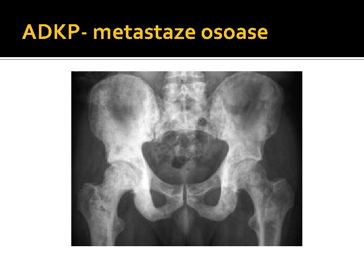 ADKP- metastaze osoase ADKP- metastaze osoase