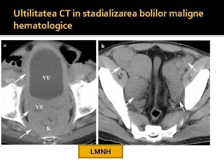 Ultilitatea CT in stadializarea bolilor maligne hematologice LMNH Ultilitatea CT in stadializarea bolilor maligne hematologice LMNH